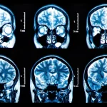 The Role of Neuroimaging in the Diagnosis of Neurological Disease