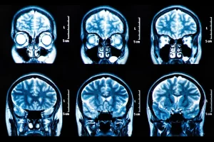 The Role of Neuroimaging in the Diagnosis of Neurological Disease