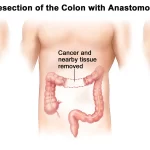 The Role of Surgery in Treating Colon Cancer