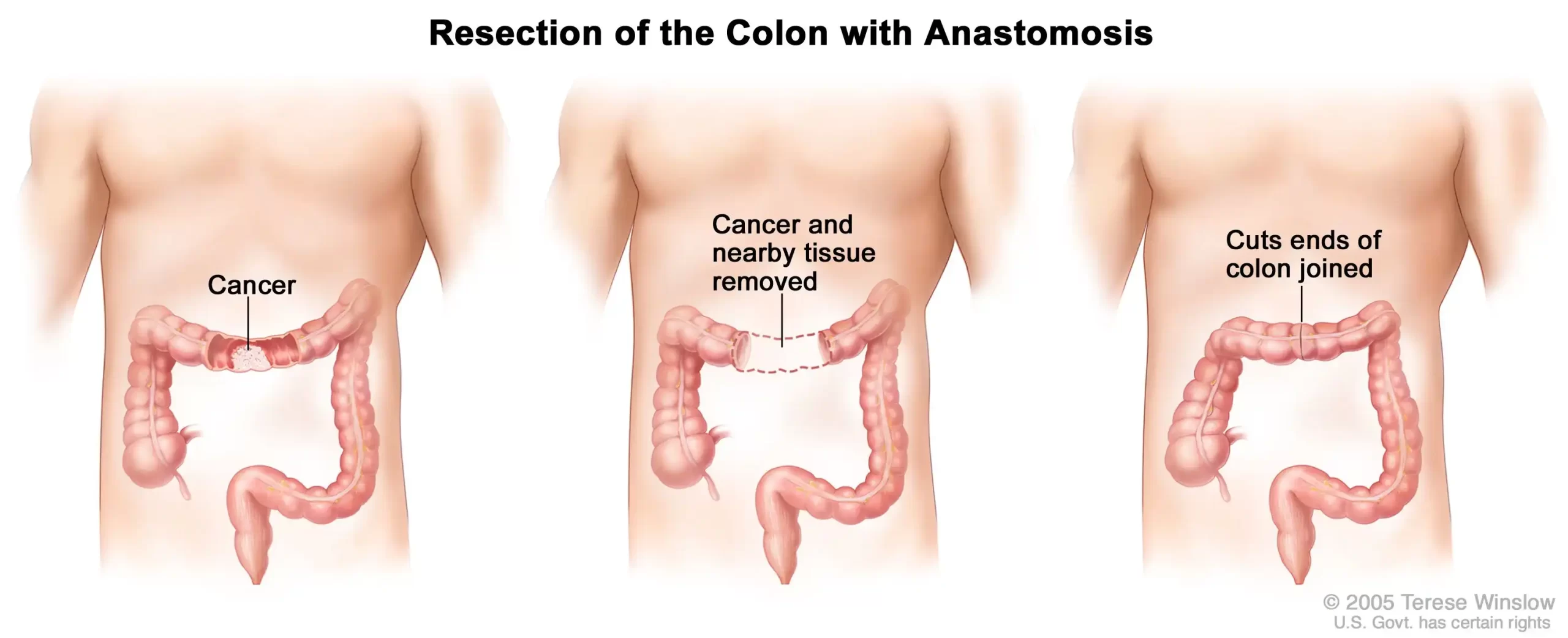 The Role of Surgery in Treating Colon Cancer